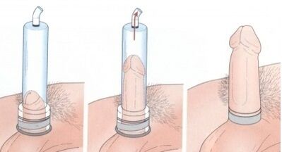 Penis enlargement with pump