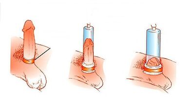 Principle of operation of the pump to increase the penis
