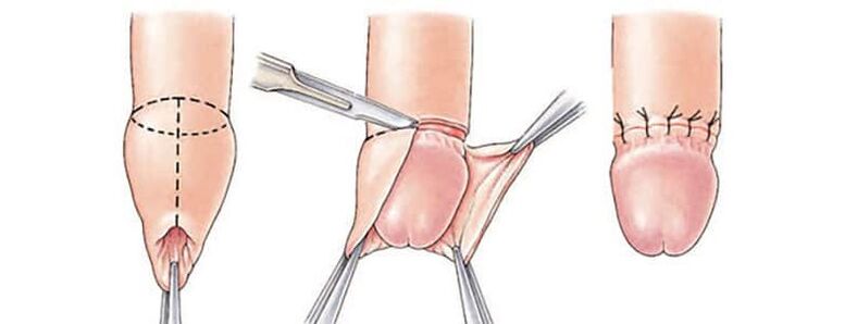 The influence of circumcision on the size of the penis